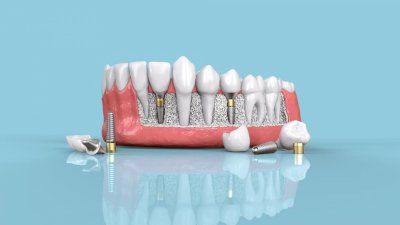 Ученые считают, что зубные импланты опасны