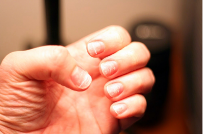 Медики рассказали, на какие болезни указывают белые пятна на ногтях
