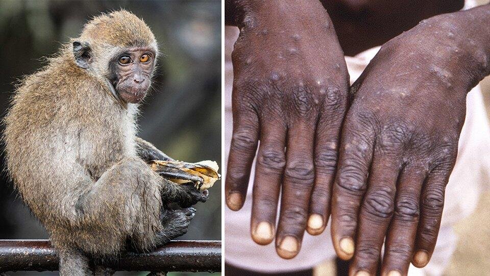 «Cитуация резко переломится»: грозит ли России эпидемия оспы обезьян?
